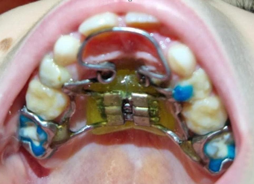 Окклюзионная фотография ранее установленного назубного расширителя верхней челюсти.